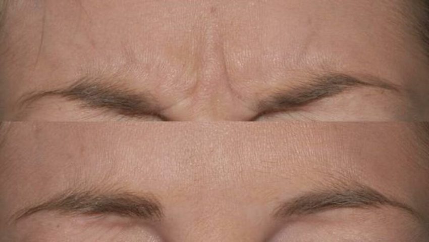 از بین بردن خط اخم با ۱۱ روش طبیعی و خانگی