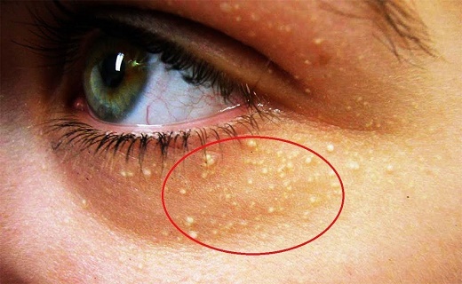 حالتی هشداردهنده روی پوست که از کلسترول بالا حکایت دارد|خبر فوری