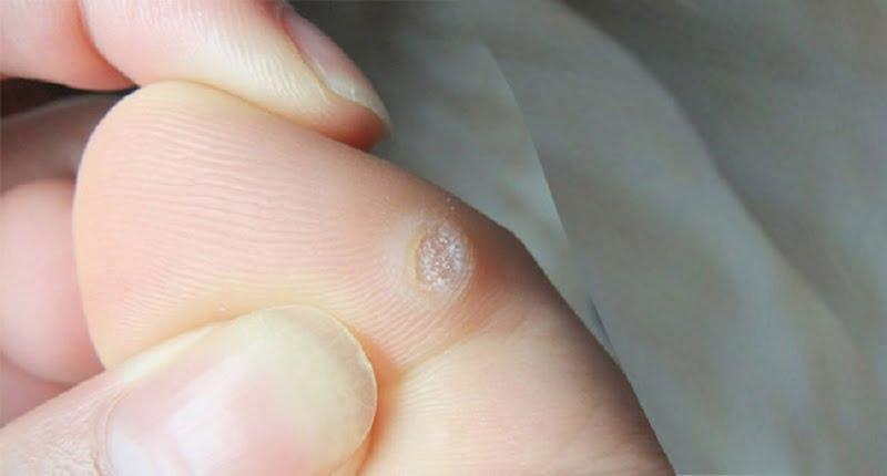 روش‌های گوناگون درمان میخچه