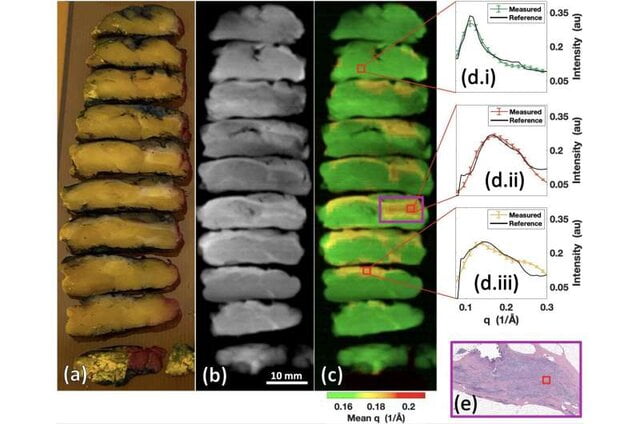 تشخیص سرطان در چند دقیقه با کمک اشعه ایکس|خبر فوری