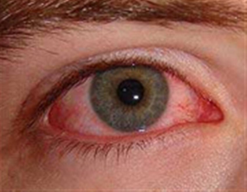 شما هم پس از تزریق واکسن کرونا عوارض چشمی داشتید؟