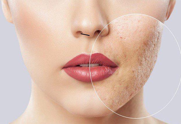 نحوه تزريق مزوتراپي صورت