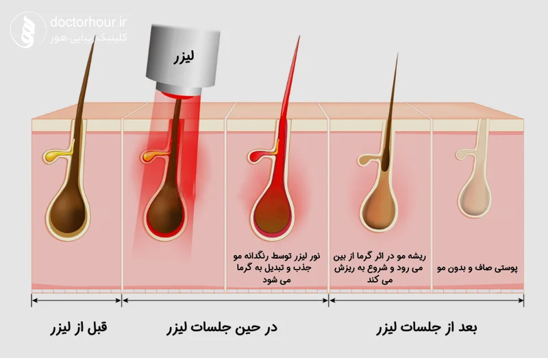 بهترین مرکز لیزر موهای زائد در قم